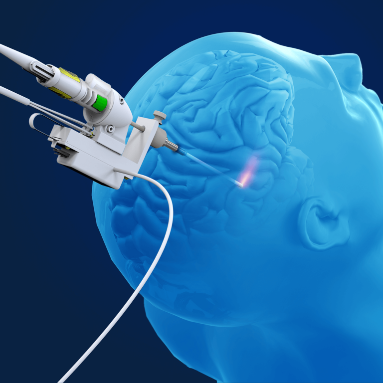 The NeuroBlate® Laser Ablation System Monteris