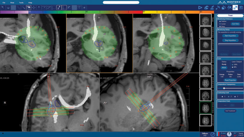 NeuroBlate Fusion™ Software | Monteris