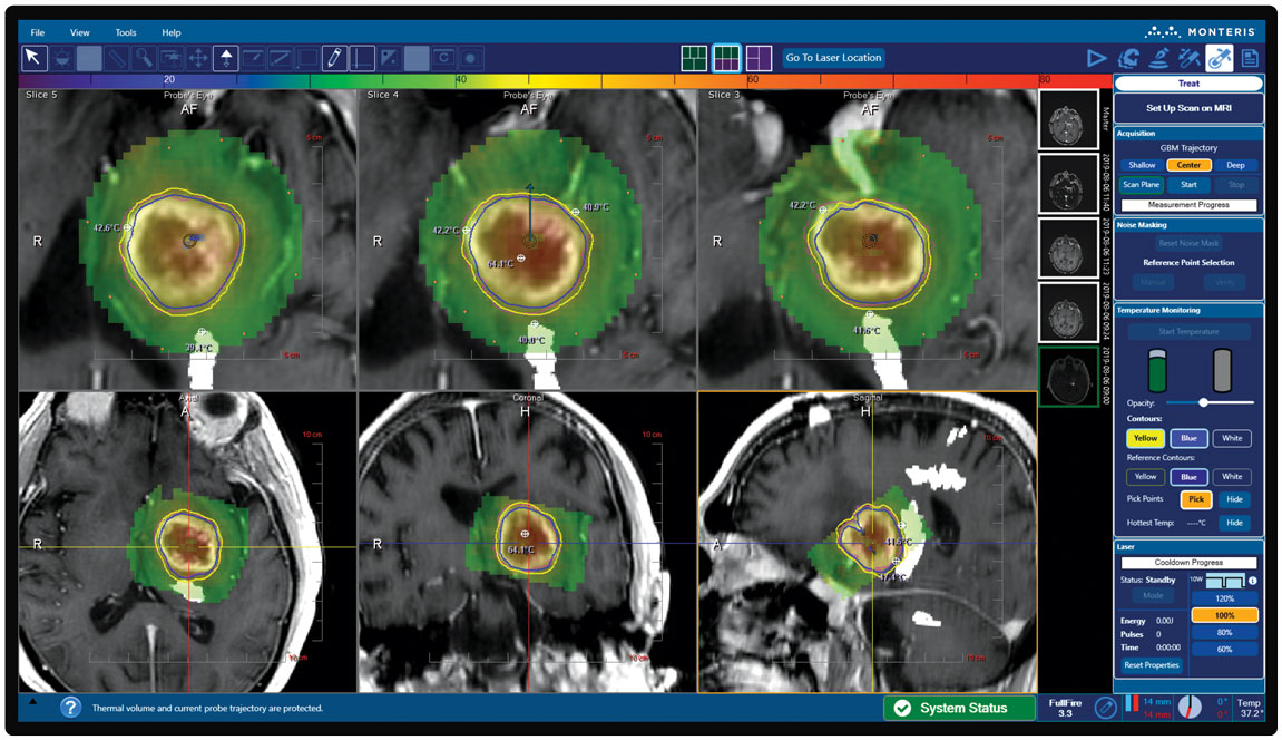 NeuroBlate Fusion-S Software - Monteris